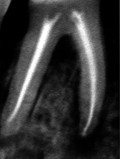 Radiografia de outro molar com os canais tratados, preenchidos em branco até a ponta das raízes.