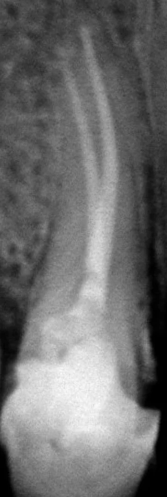 Radiografia de um dente com o canal tratado, uma linha branca da coroa até a ponta da raiz.