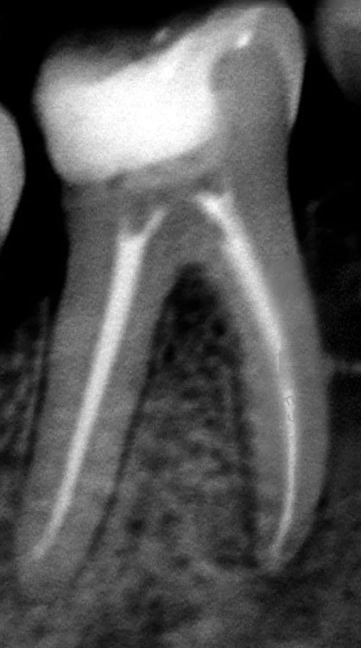 Radiografia de um molar inferior depois do tratamento de canal: a restauração branca na coroa, a câmara logo abaixo, os dois canais preenchidos como linhas brancas até a ponta das raízes e o osso em volta.